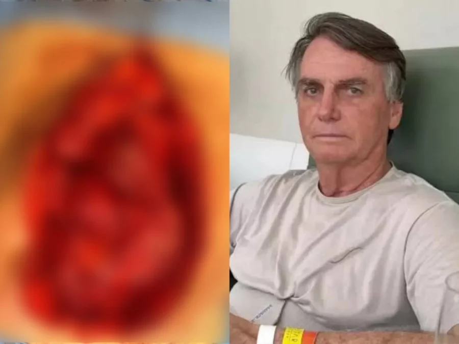 cirurgia de Bolsonaro
